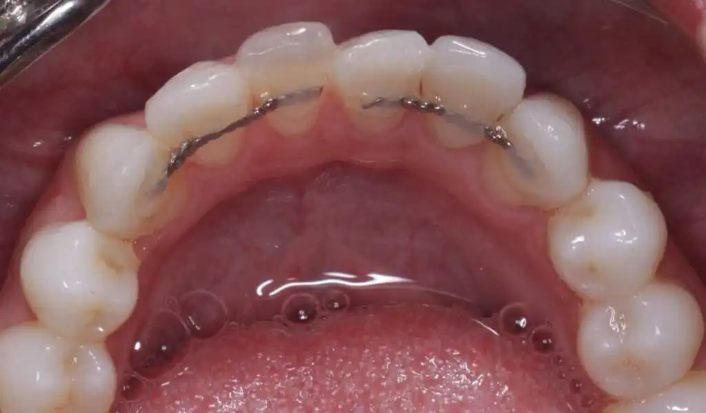 An example of a broken wire retainer